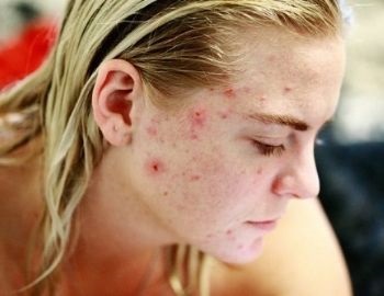 padecimientos de la piel que aparecen con el estr�s