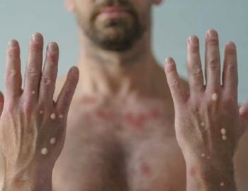 todo lo que necesitas saber para no contraer la viruela del mono